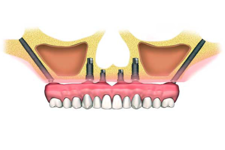 Implantes zigomáticos